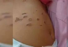 Menina de 10 meses foi queimada por cigarros na barriga e nas pernas
